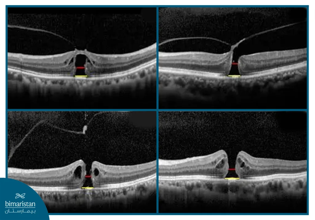 The Image Depicts The Stages Of Macular Hole Progression: Early Separation, Partial Tear, Full-Thickness Hole, And Complete Vitreous Detachment