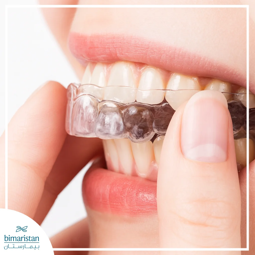 The Image Shows A Night Guard Used To Protect Teeth From Grinding.