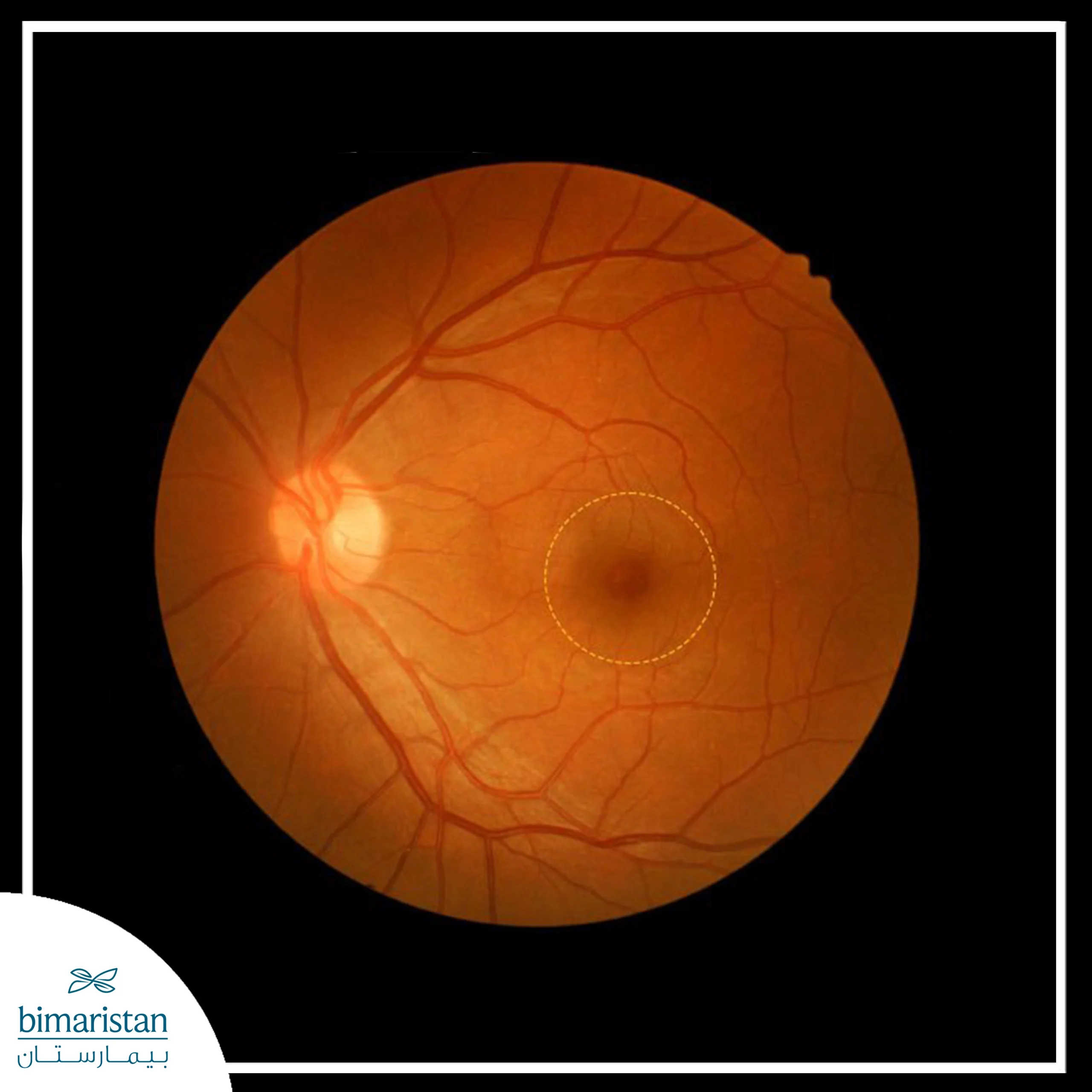 The Image Shows A Retinal Fundus Photo Highlighting The Macula At The Center Of The Retina, Which Is Responsible For Sharp Central Vision