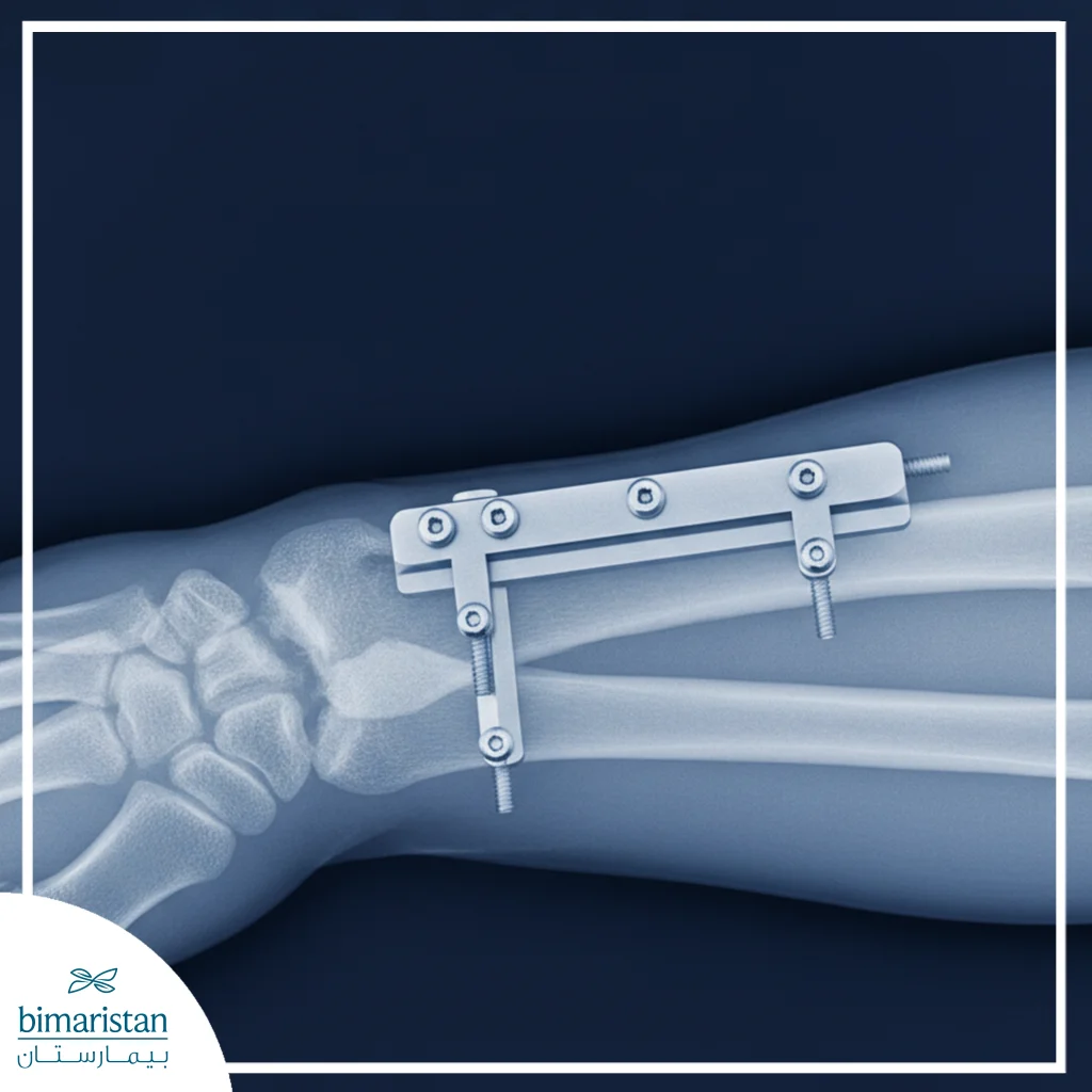 The Image Shows Forearm Fracture Fixation Using A Bio-Plate.