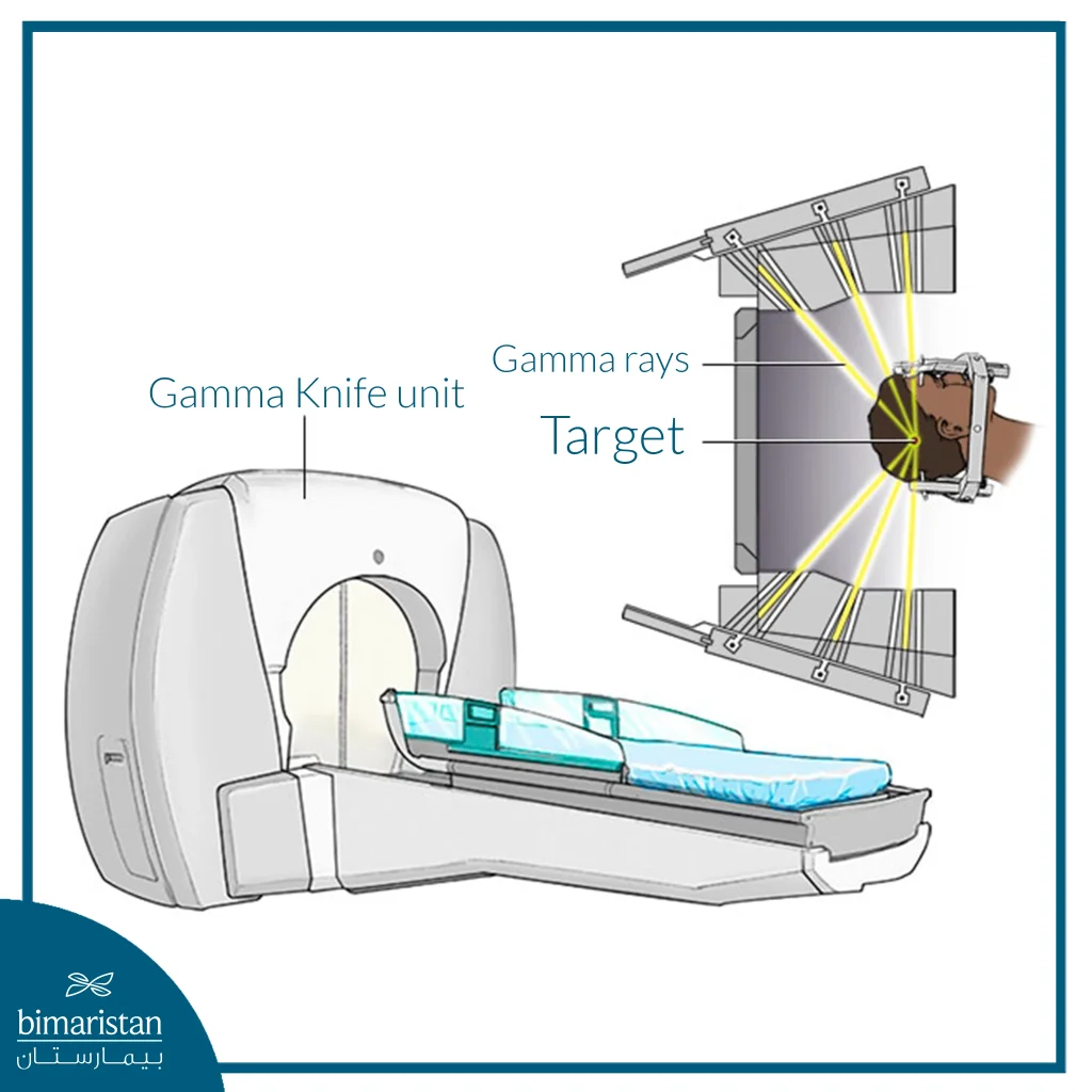The Image Illustrates How Multiple Gamma Rays Accurately Target A Brain Tumor Without The Need For Surgery