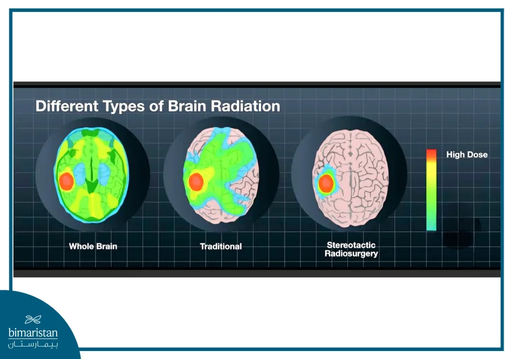 The Image Shows How Radiation Doses Vary Across Methods, With Stereotactic Brain Radiosurgery Focusing Precisely On The Tumor