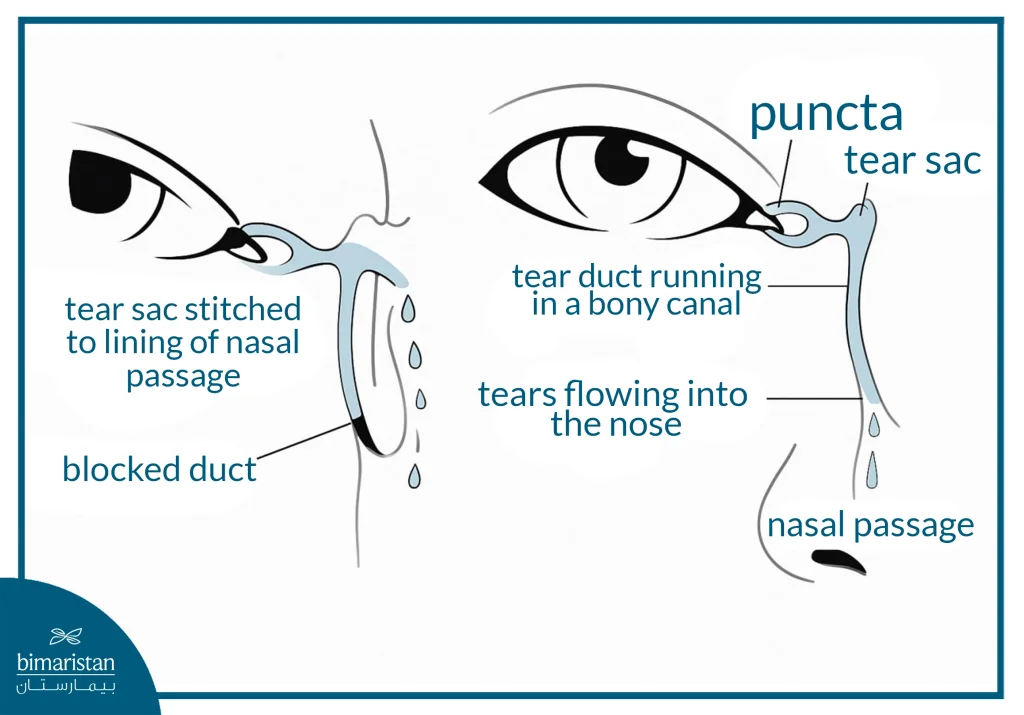 The Image Shows Normal Tear Flow Versus A Blocked Duct Surgically Reconnected To The Nasal Passage.