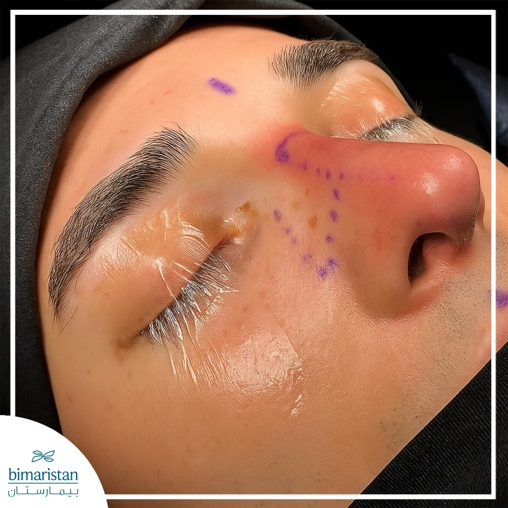 The Image Shows Patient Preparation For Laser Rhinoplasty.