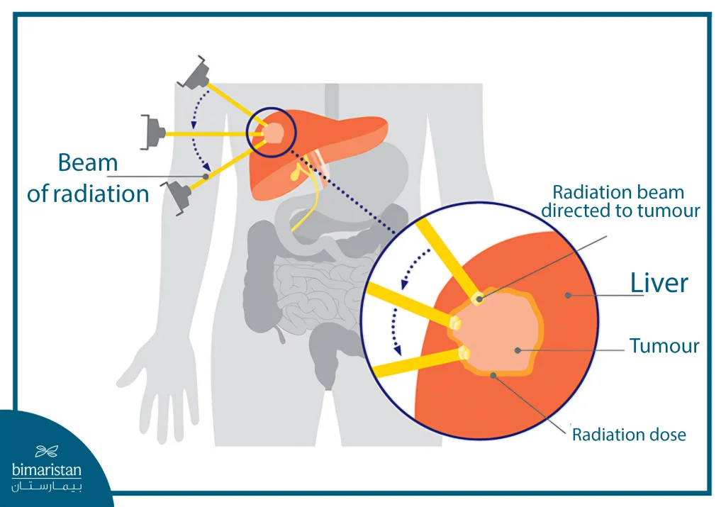 The Image Shows Radiation Beams Precisely Targeting A Liver Tumor While Minimizing Exposure To Surrounding Healthy Tissue