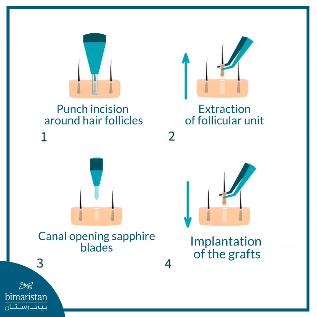The Image Shows The Sapphire Fue Steps From Follicle Extraction To Graft Implantation