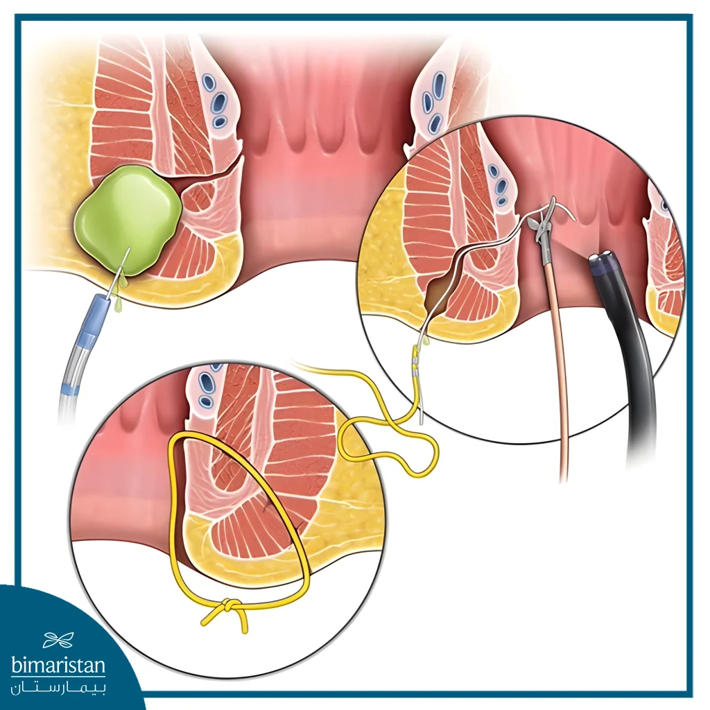 The Image Shows The Stages Of Endoscopic Anal Fistula Surgery