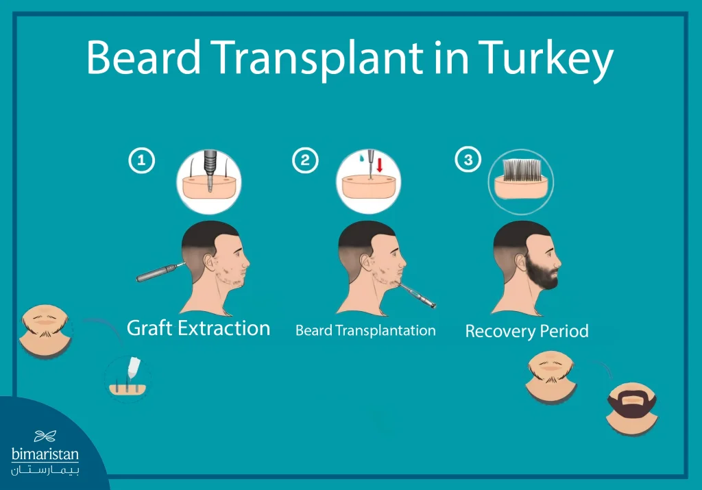 The Image Shows The Stages Of Beard Transplant In Turkey, From Graft Extraction To Recovery
