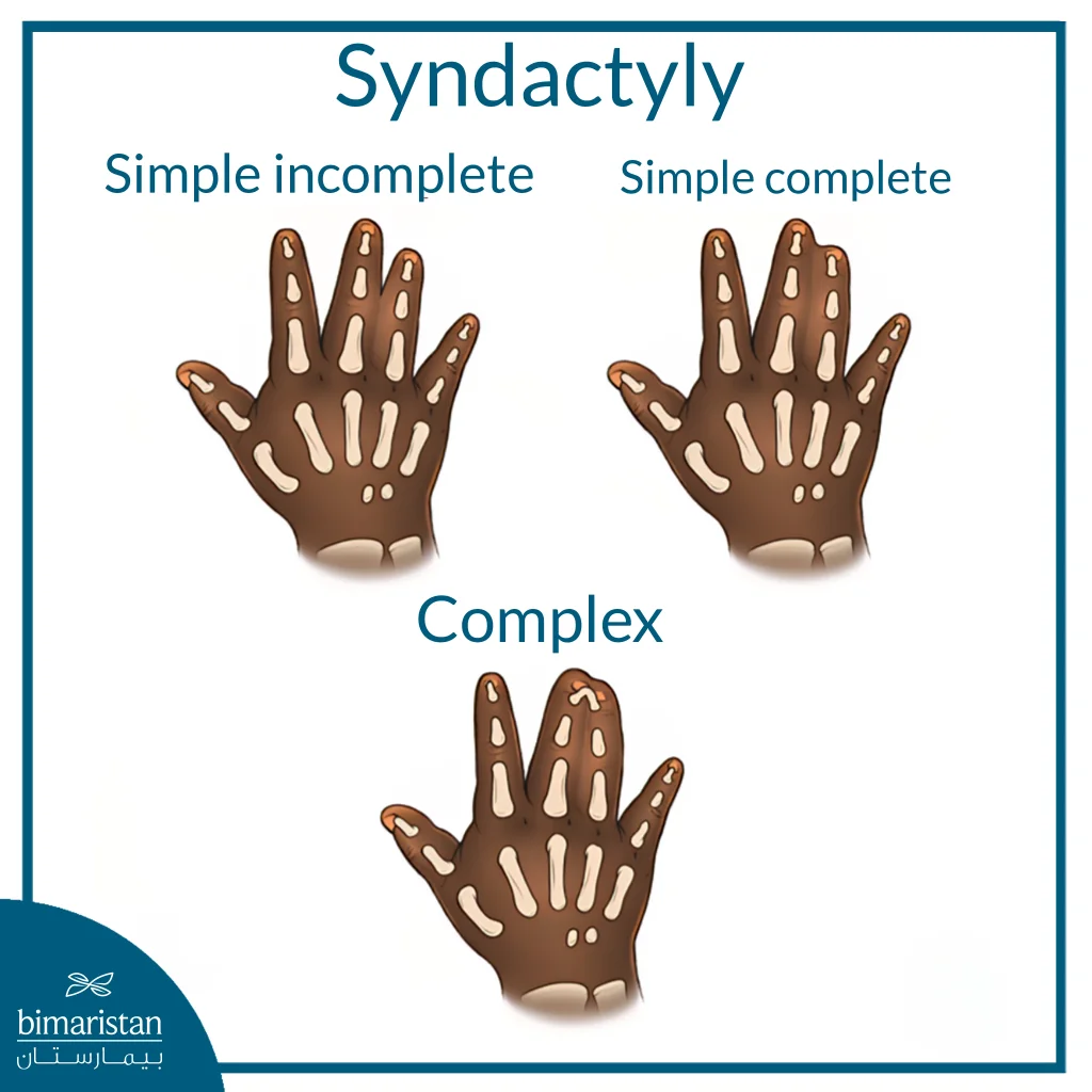 The Image Shows Types Of Syndactyly: Simple Incomplete, Simple Complete, And Complex Involving Bones Or Tendons.