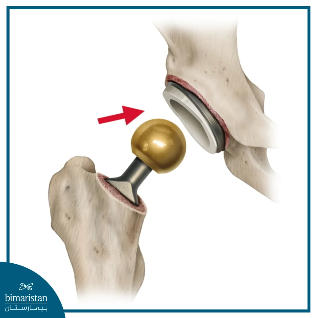 Total Hip Replacement