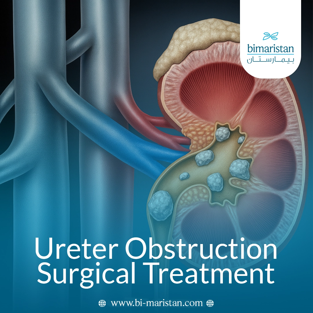 Surgical Treatment Of Ureteral Obstruction