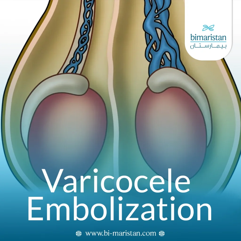 Varicocele Embolization