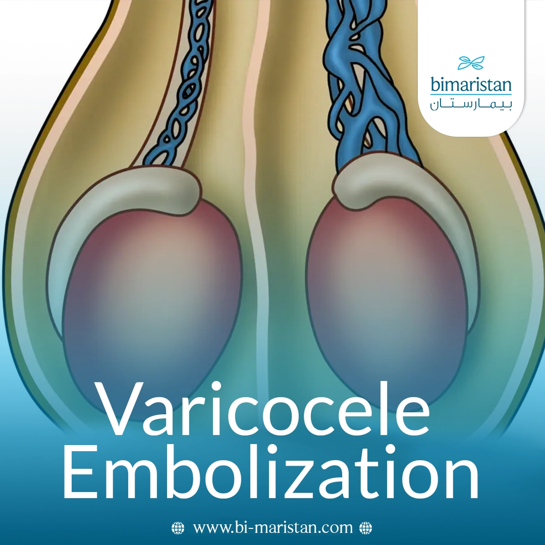 Varicocele Embolization