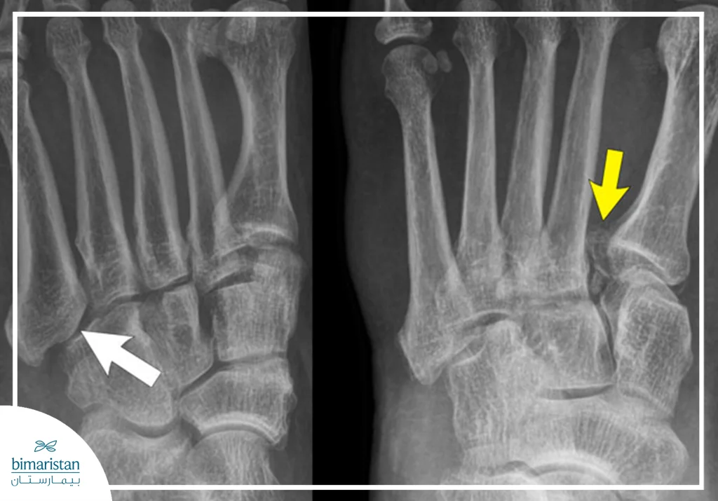 X-Ray Image Showing A Clear Fracture In The Foot