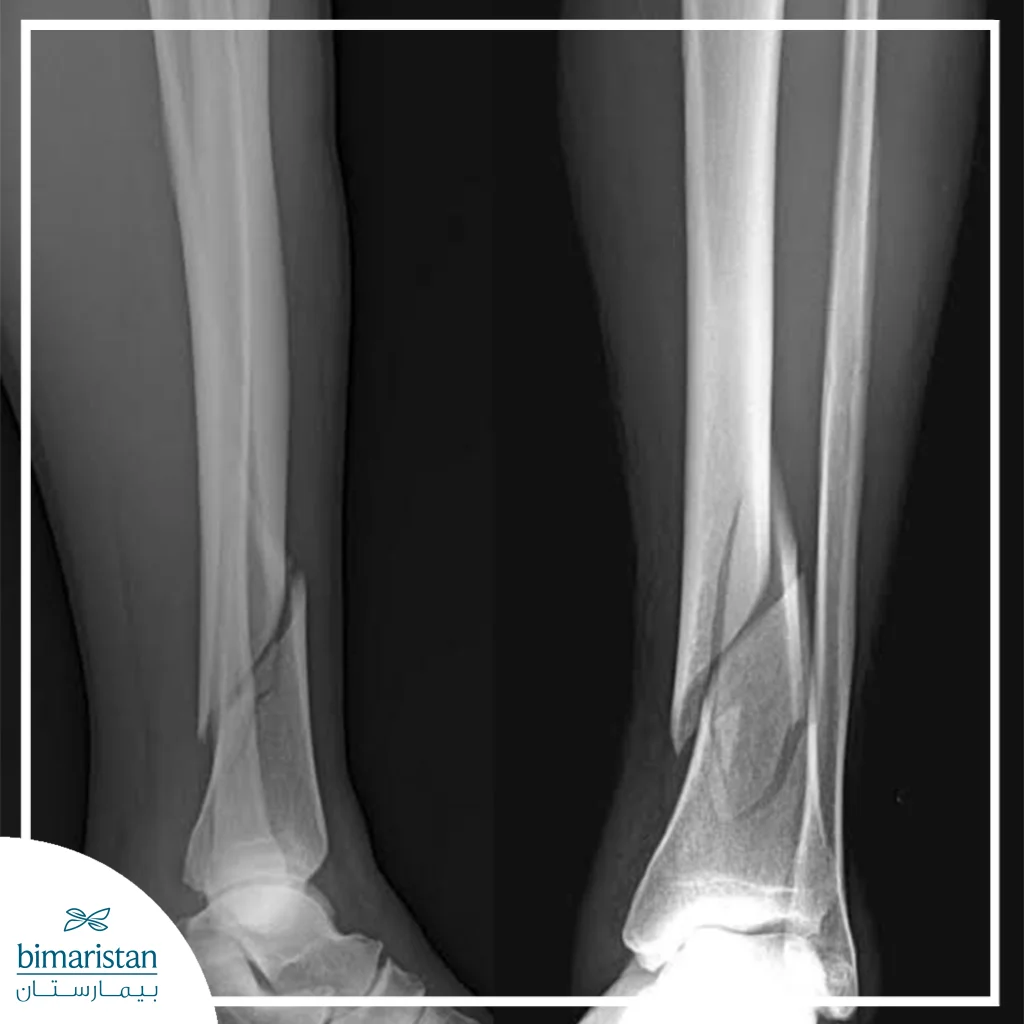 X-Ray Image Showing A Clear Fracture In The Leg