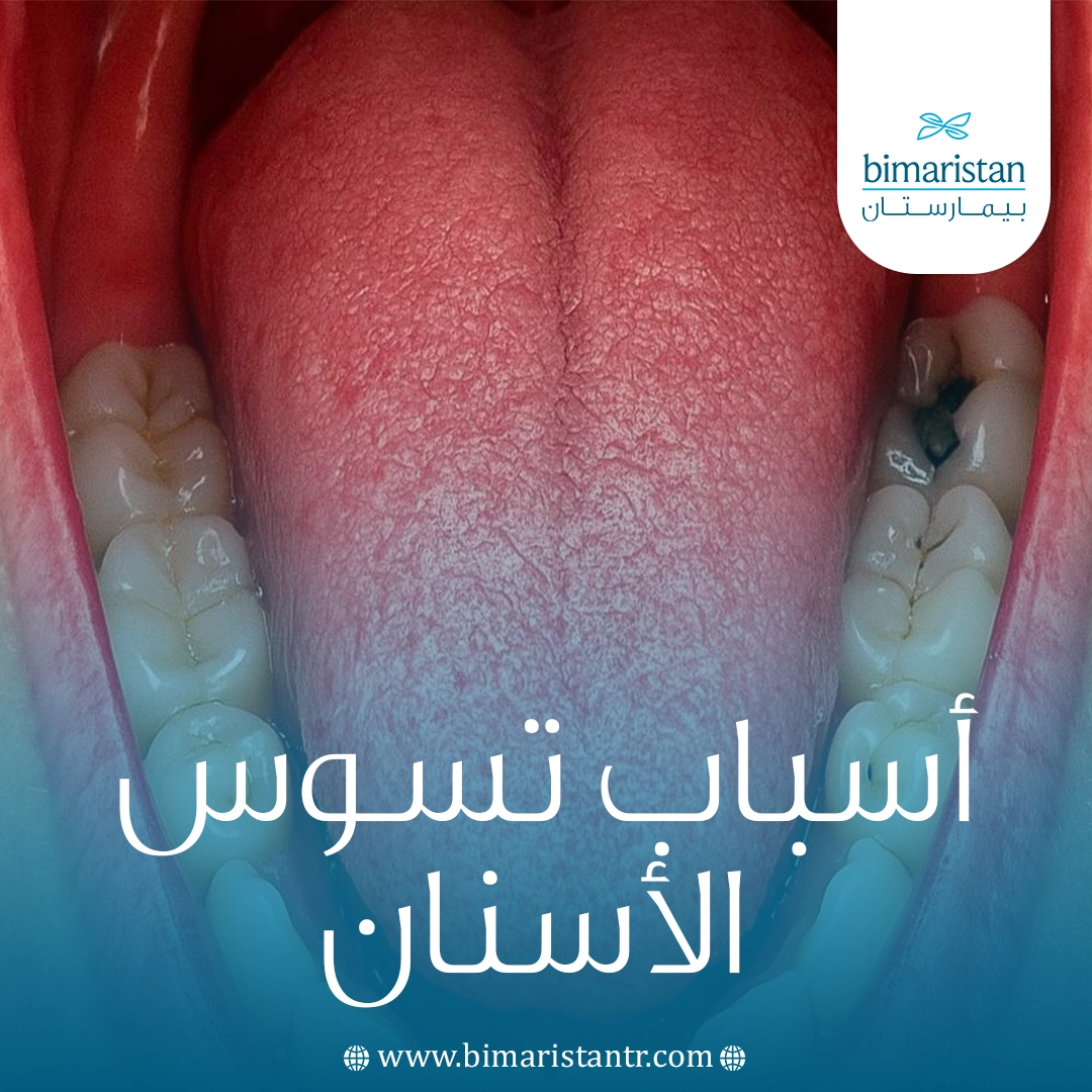 أسباب تسوس الأسنان