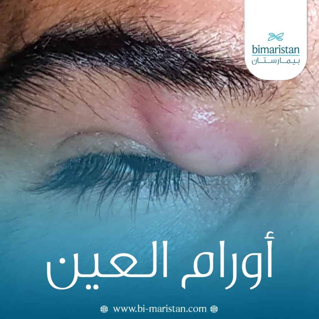 أورام العين: أنواعها وأعراضها وتشخيصها وعلاجها في تركيا 5 أورام العين
