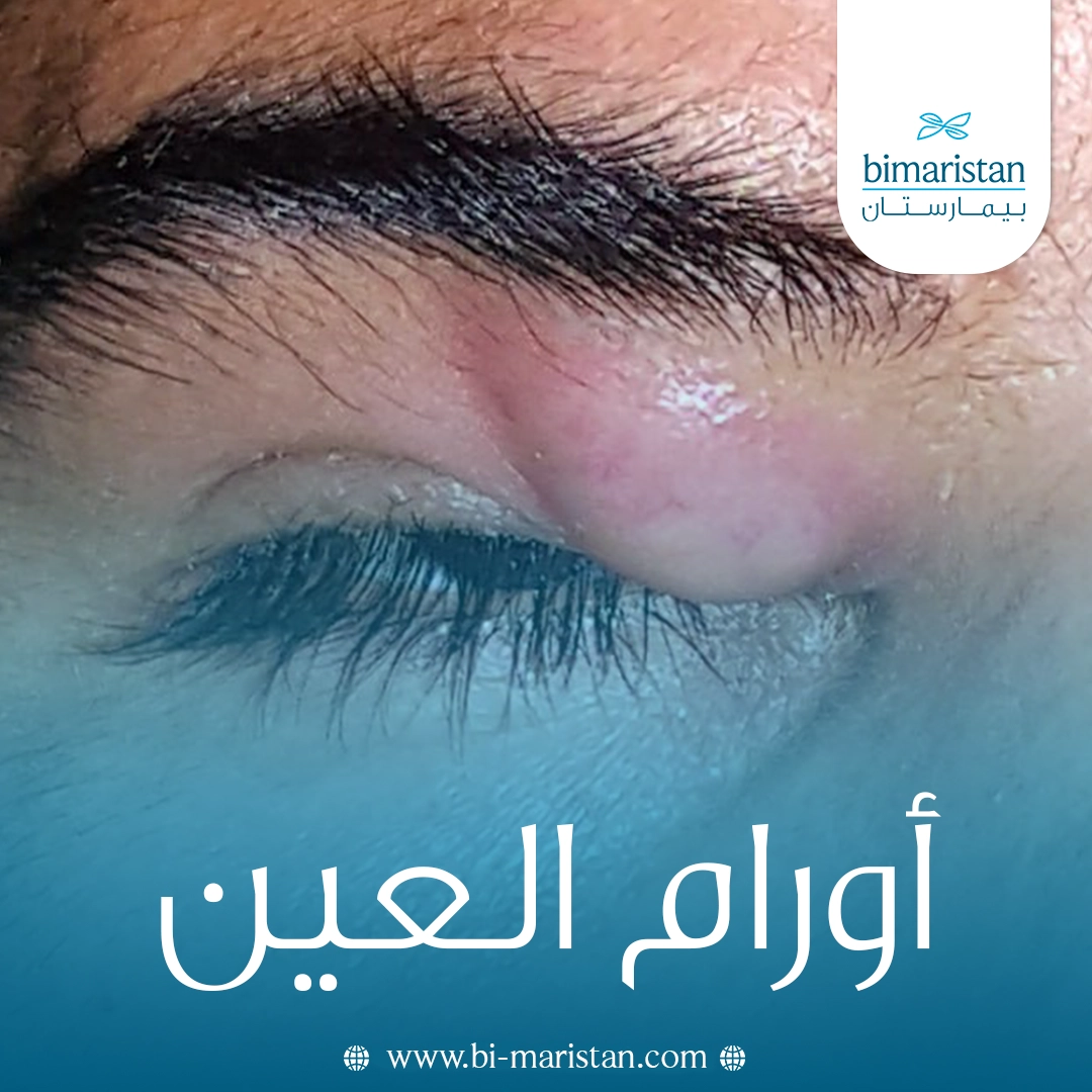 أورام العين