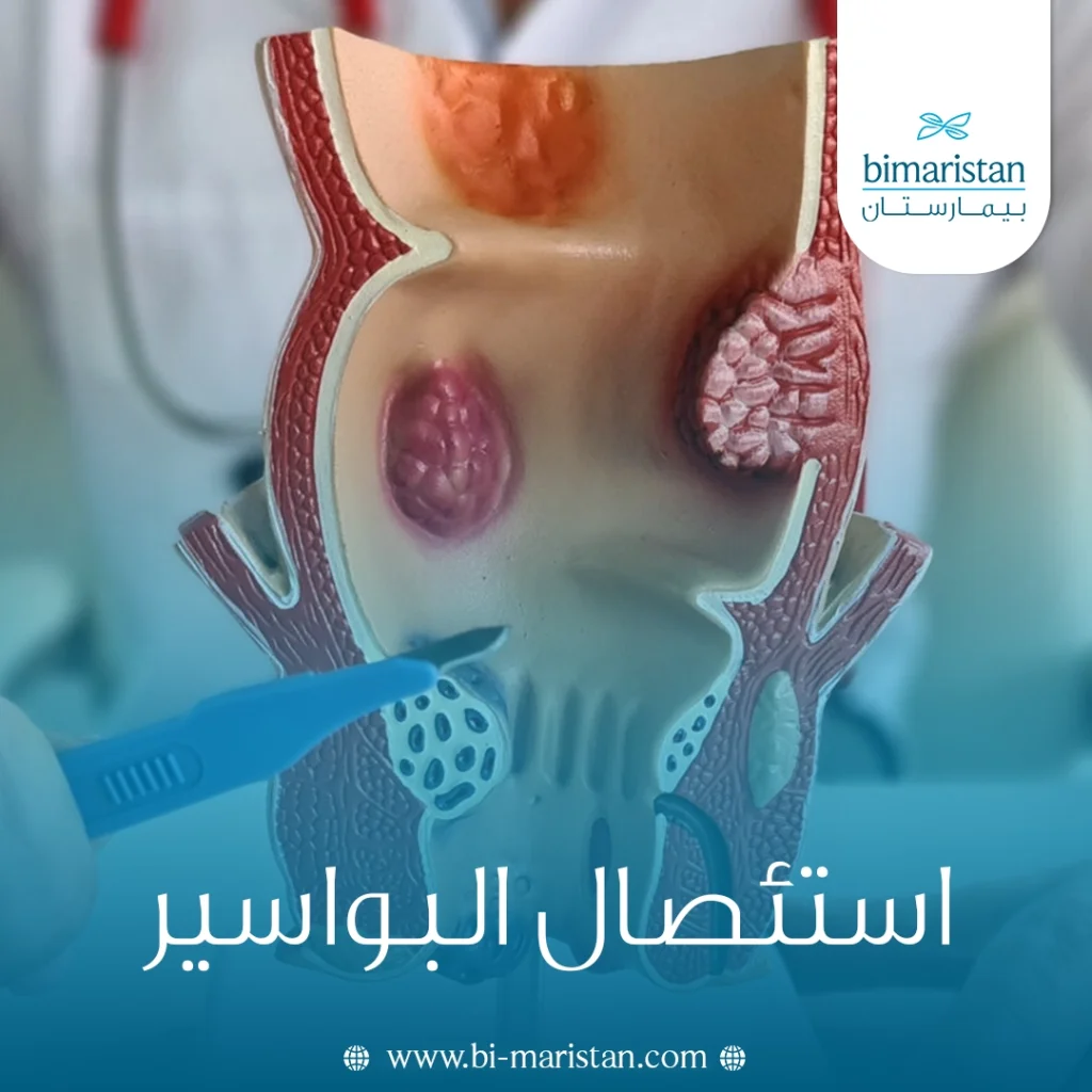 استئصال البواسير الجراحي: المخاطر وفترة الشفاء 7 استئصال البواسير