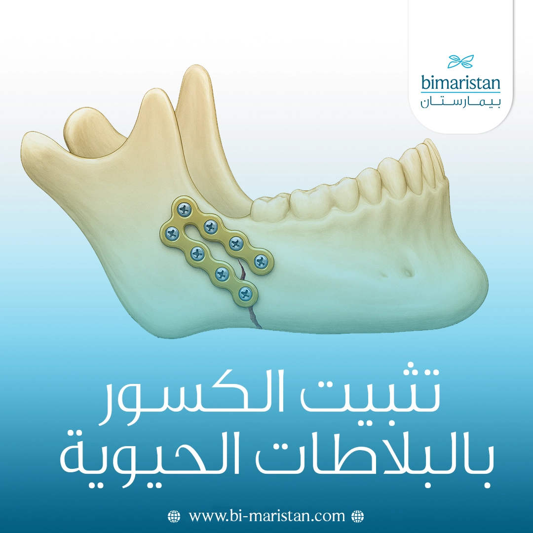 تثبيت الكسور بالبلاطات الحيوية