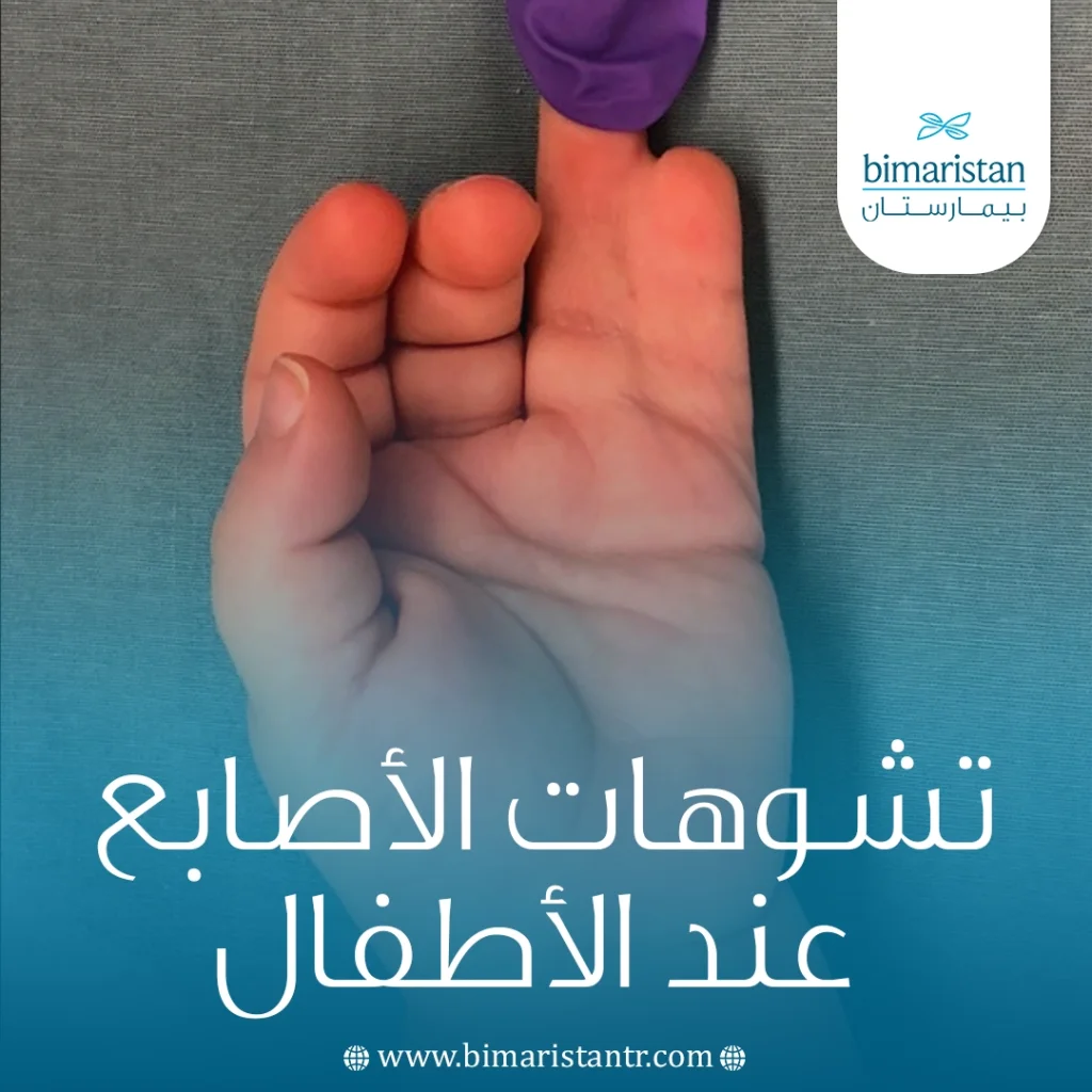 تشوهات الأصابع عند الأطفال