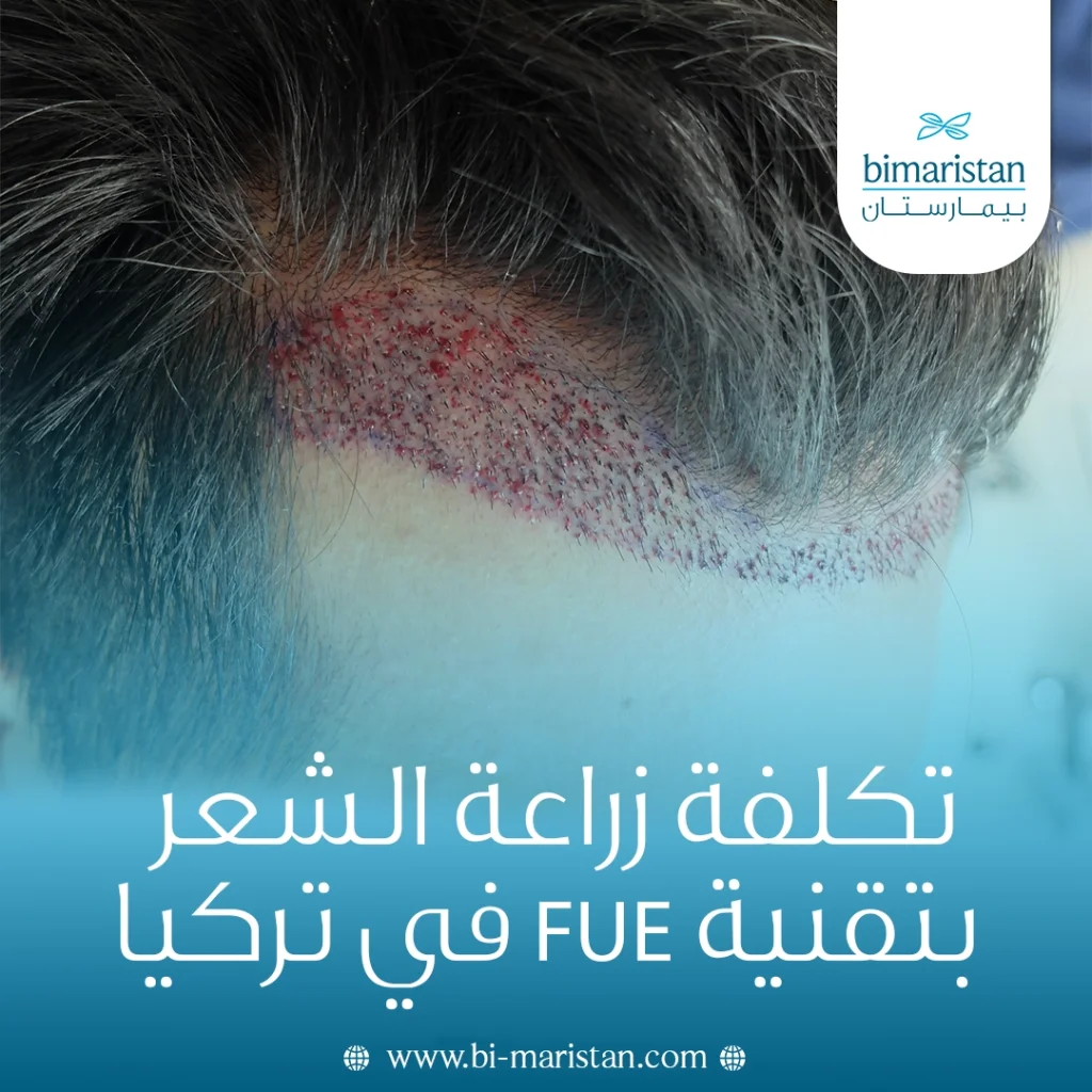 تكلفة زراعة الشعر بتقنية Fue في تركيا: أسعار تنافسية وجودة أوروبية 1 تكلفة زراعة الشعر بتقنية Fue في تركيا