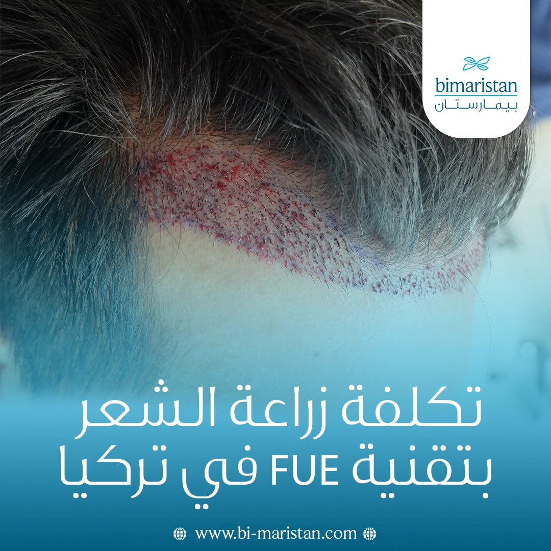 تكلفة زراعة الشعر بتقنية Fue في تركيا: أسعار تنافسية وجودة أوروبية 2 تكلفة زراعة الشعر بتقنية Fue في تركيا: أسعار تنافسية وجودة أوروبية