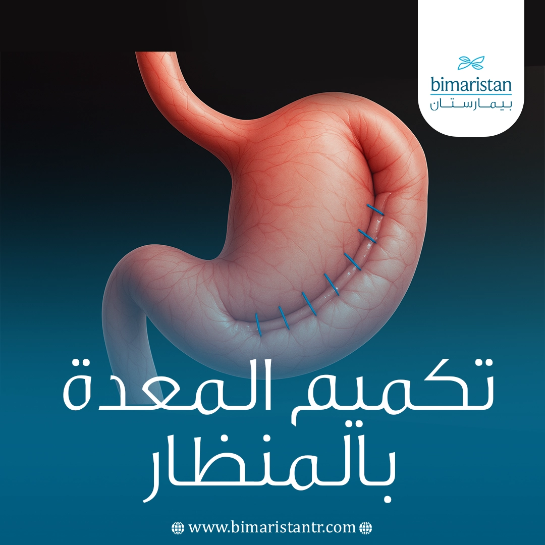 تكميم المعدة بالمنظار