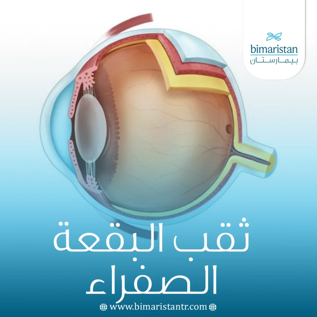 ثقب البقعة الصفراء