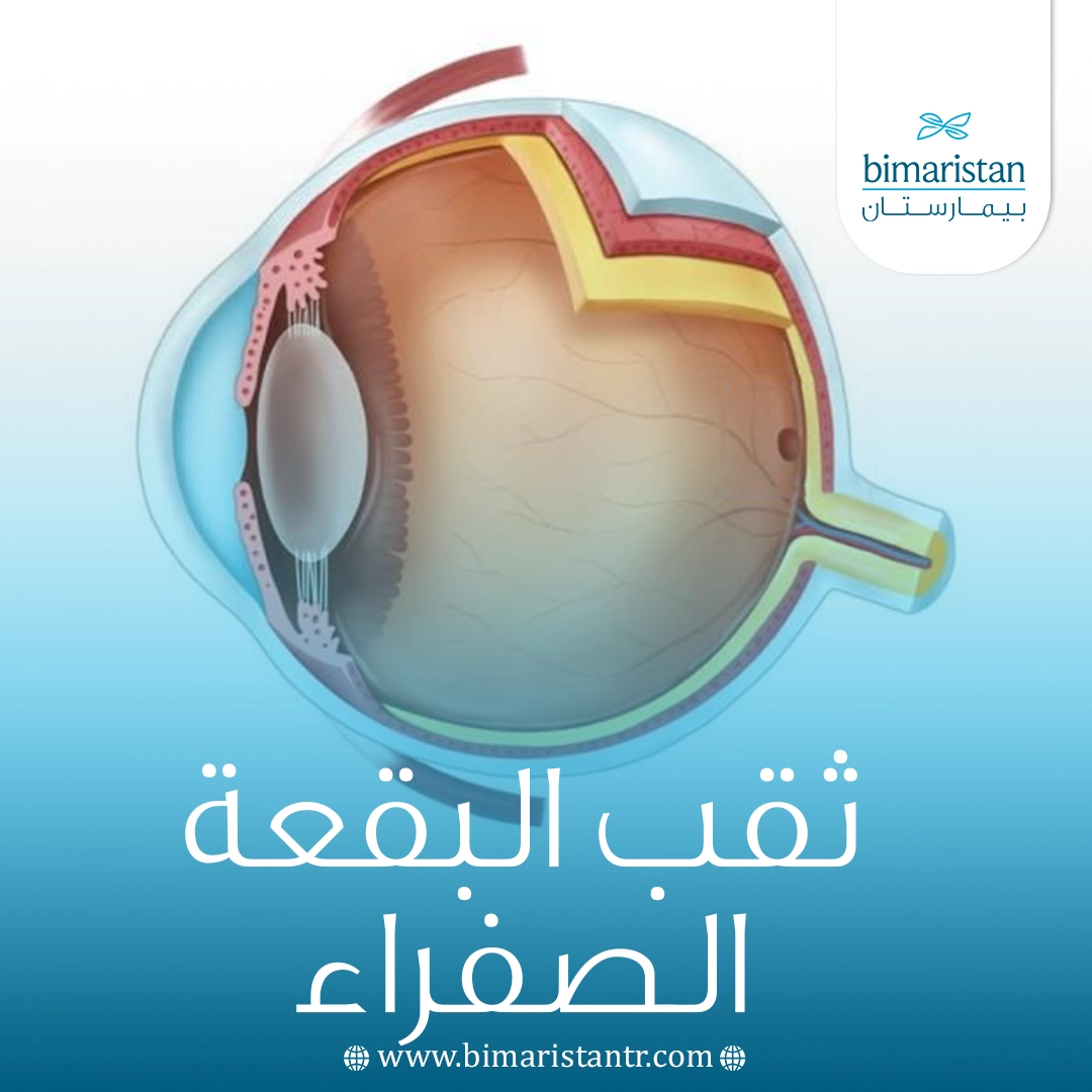 ثقب البقعة الصفراء