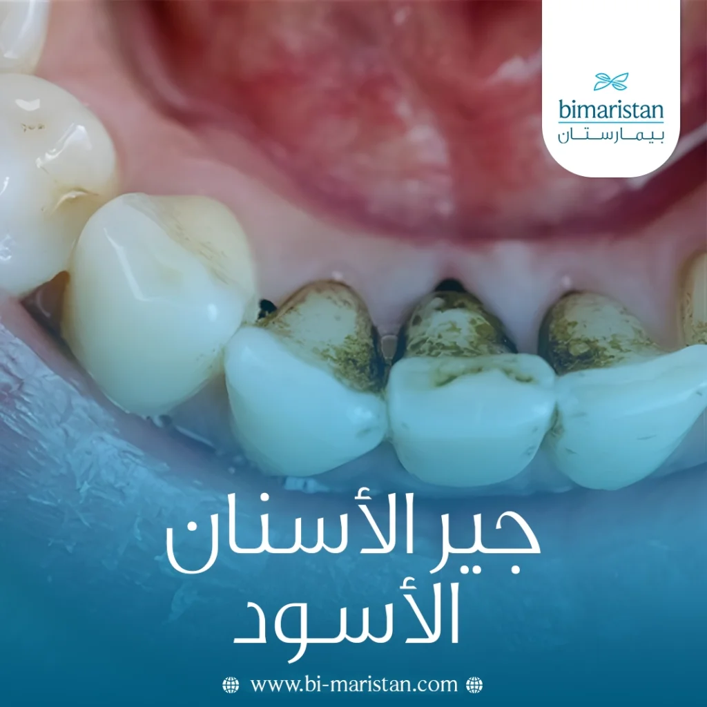 جير الأسنان الأسود