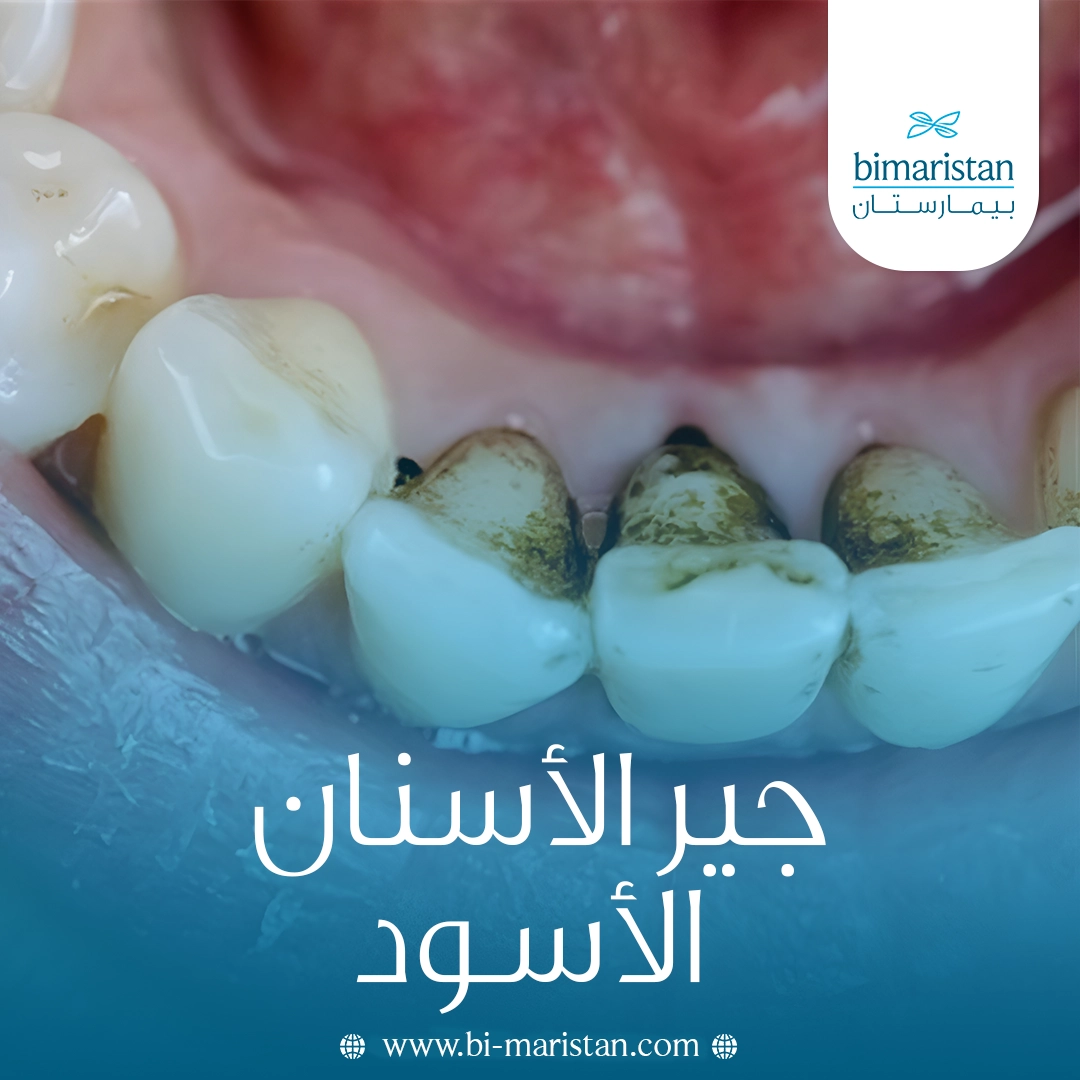 جير الأسنان الأسود