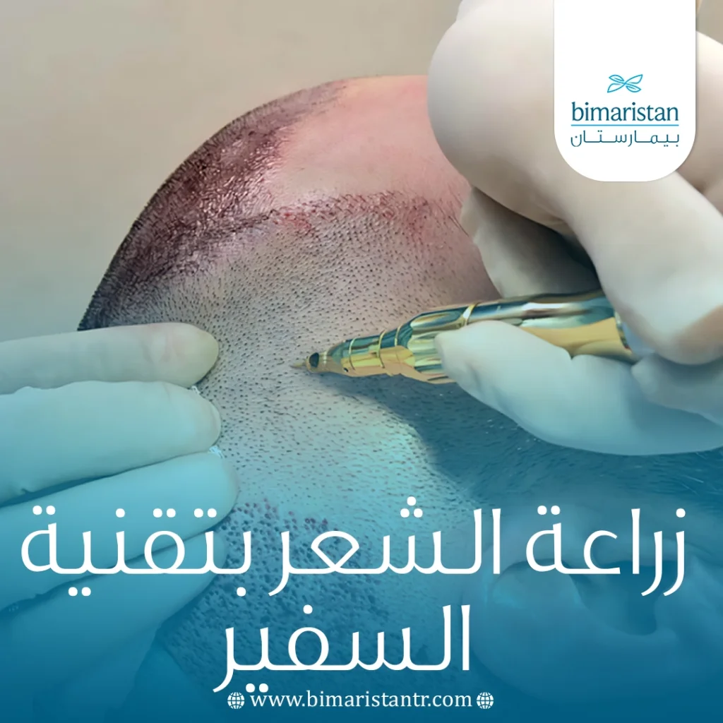زراعة الشعر بتقنية السفير