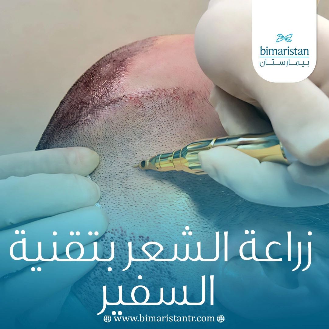زراعة الشعر بتقنية السفير