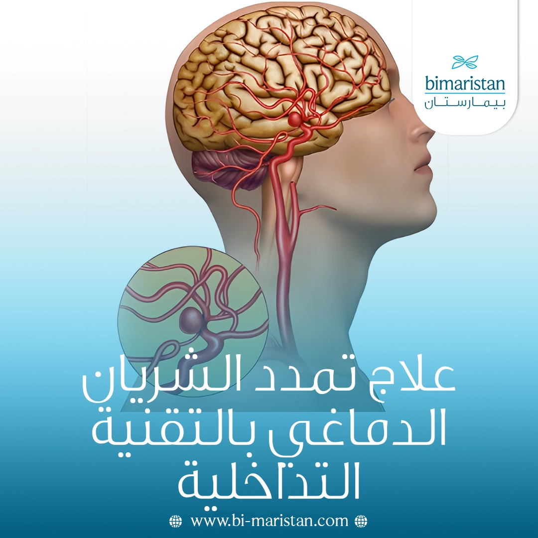 علاج تمدد الشريان الدماغي بالتقنية التداخلية