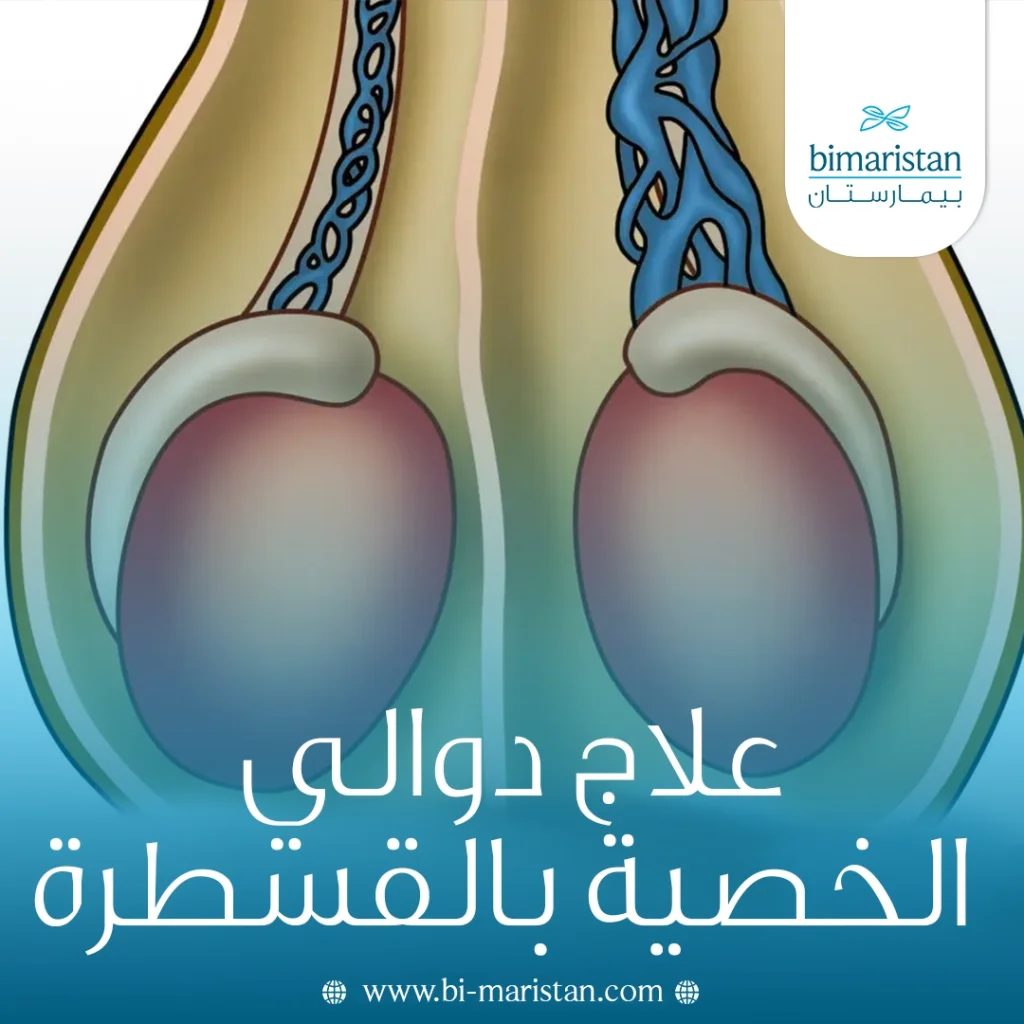 علاج دوالي الخصية بالقسطرة