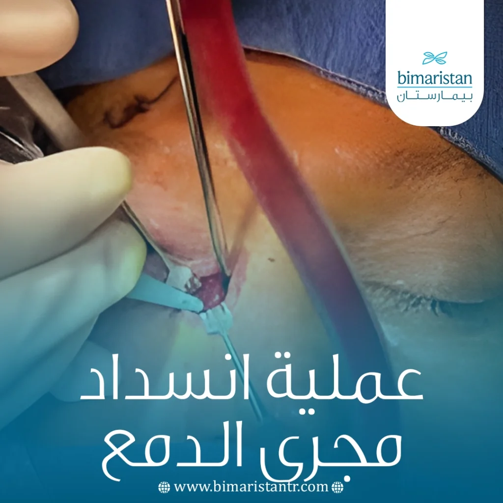 عملية انسداد مجرى الدمع