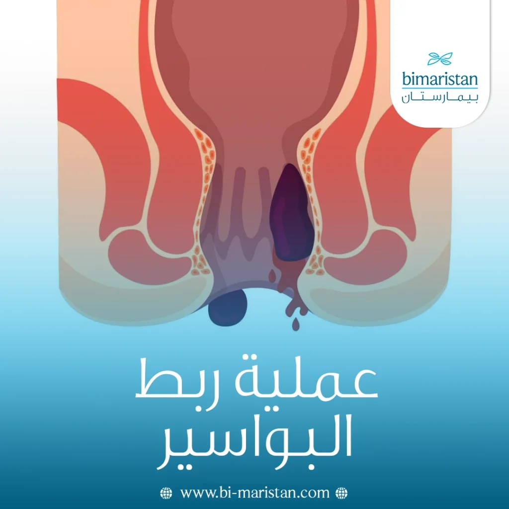 عملية ربط البواسير