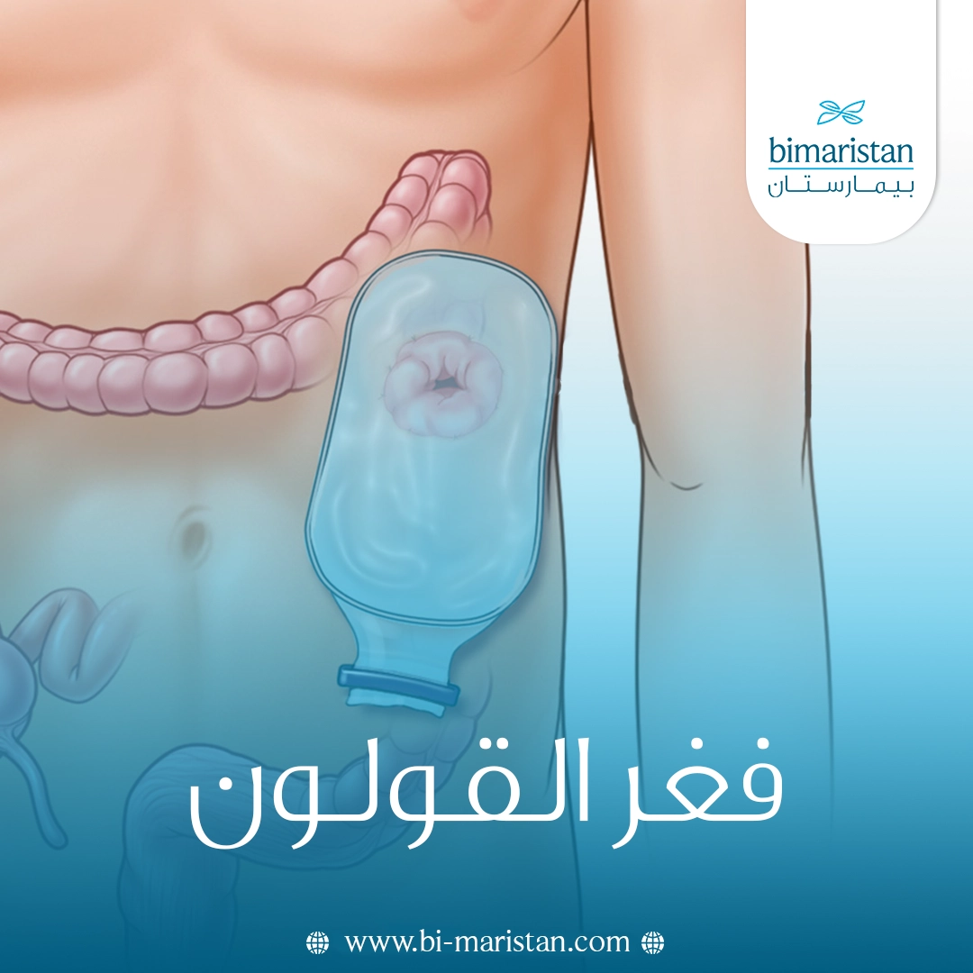 فغر القولون