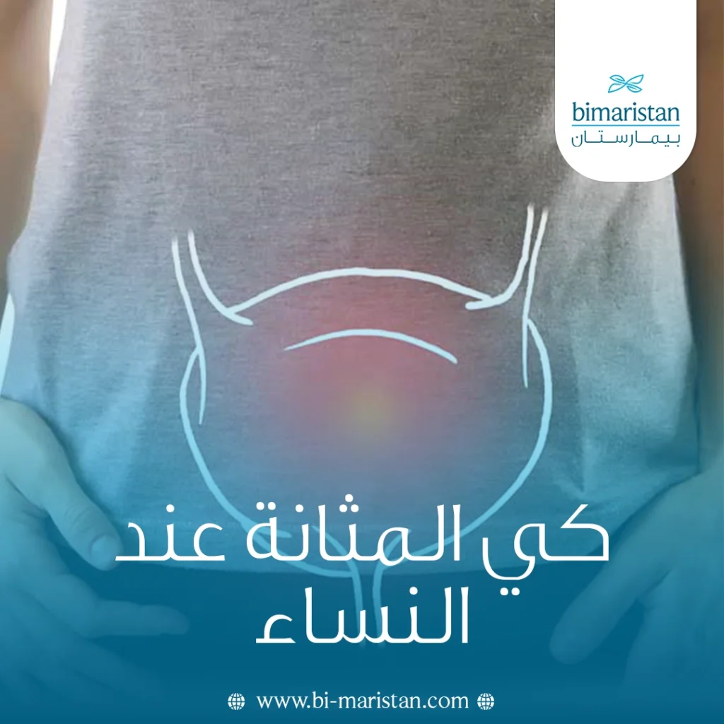 كي المثانة عند النساء