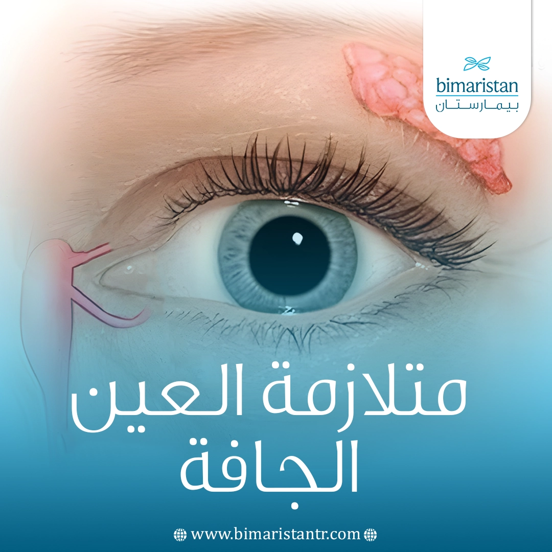 متلازمة العين الجافة