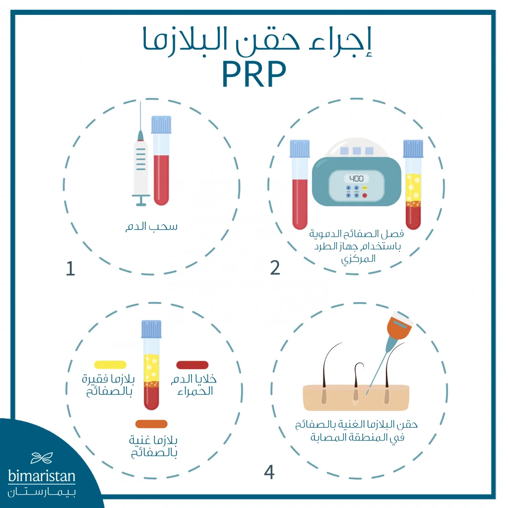 توضح هذه الصورة المراحل الأساسية لتحضير البلازما الغنية بالصفائح Prp