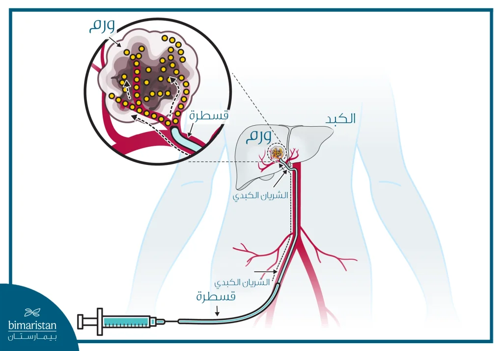 رسم يوضّح إيصال العلاج إلى ورم الكبد من خلال قسطرة تُدخل عبر الشريان الفخذي وصولًا إلى الشريان الكبدي.
