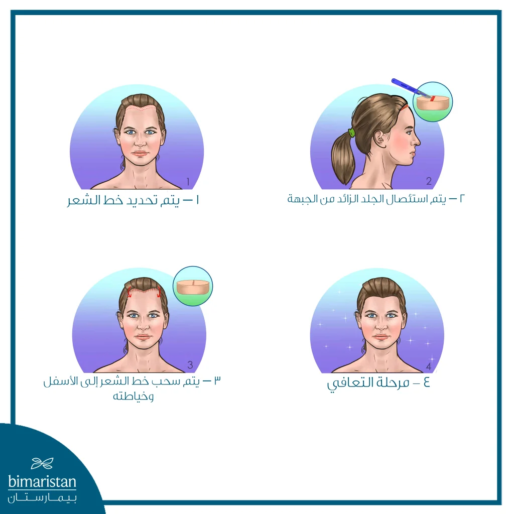 رسم يوضّح الخطوات الأساسية لعملية خفض خط الشعر، من تحديد الخط إلى إزالة الجلد الزائد ثم سحب خط الشعر وخياطته وصولًا لمرحلة التعافي.