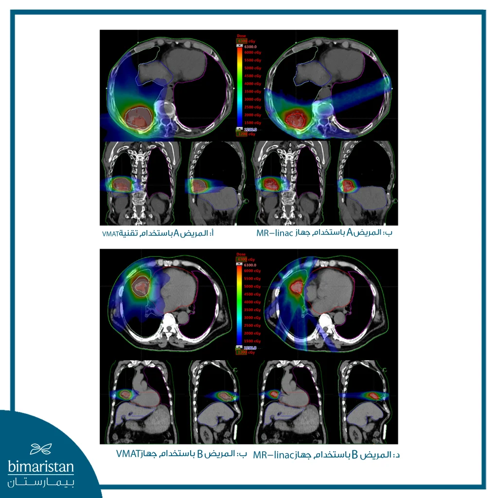 صور مقارنة تُظهر خرائط جرعات العلاج الإشعاعي لمرضى باستخدام Vmat مقابل Mr-Linac.