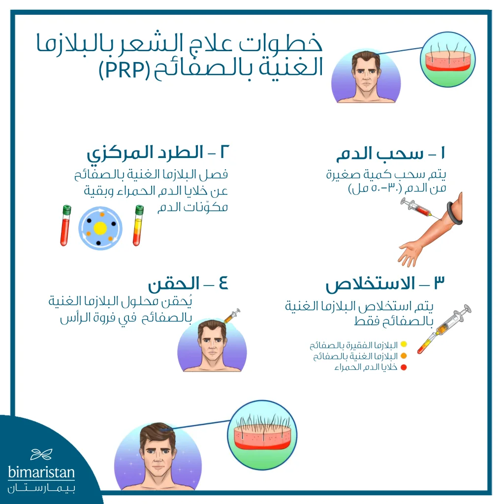 تكلفة حقن البلازما للشعر في تركيا 2025: الأسعار وطريقة العلاج ومدة النتائج 2 مخطط يوضّح الخطوات الأساسية لعلاج تساقط الشعر بالبلازما الغنية بالصفائح (Prp) من سحب الدم إلى الحقن.