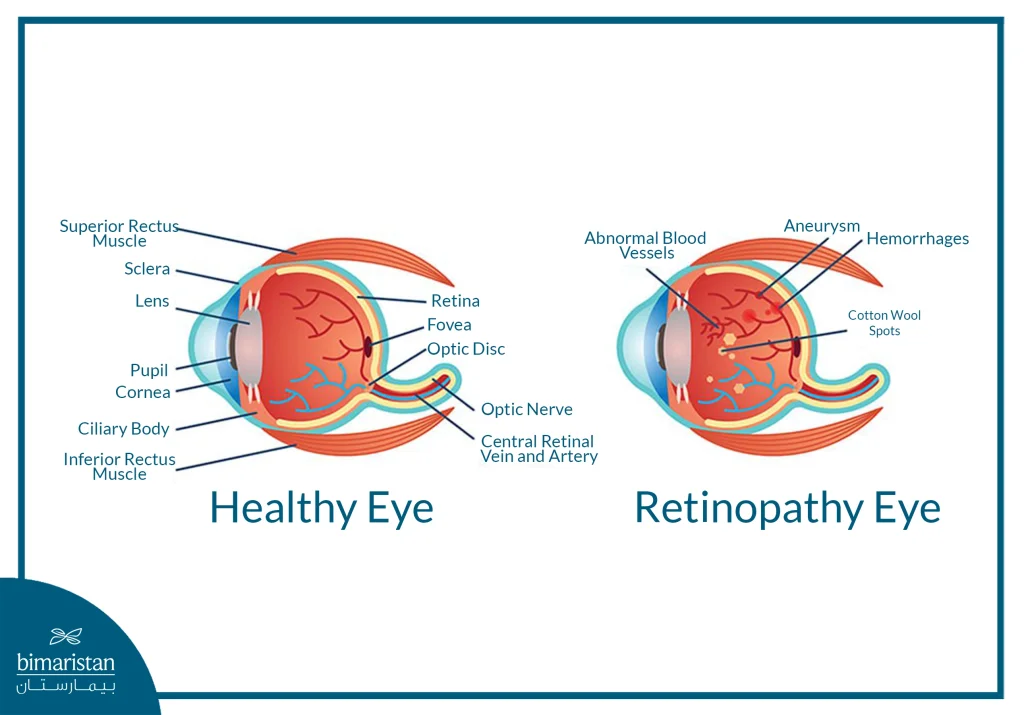 This Image Presents An Anatomical Comparison Between A Healthy Eye And A Diabetic Eye, Highlighting Pathological Changes Such As Hemorrhages, Microaneurysms, And Cotton Wool Spots Caused By Damage To The Retinal Blood Vessels