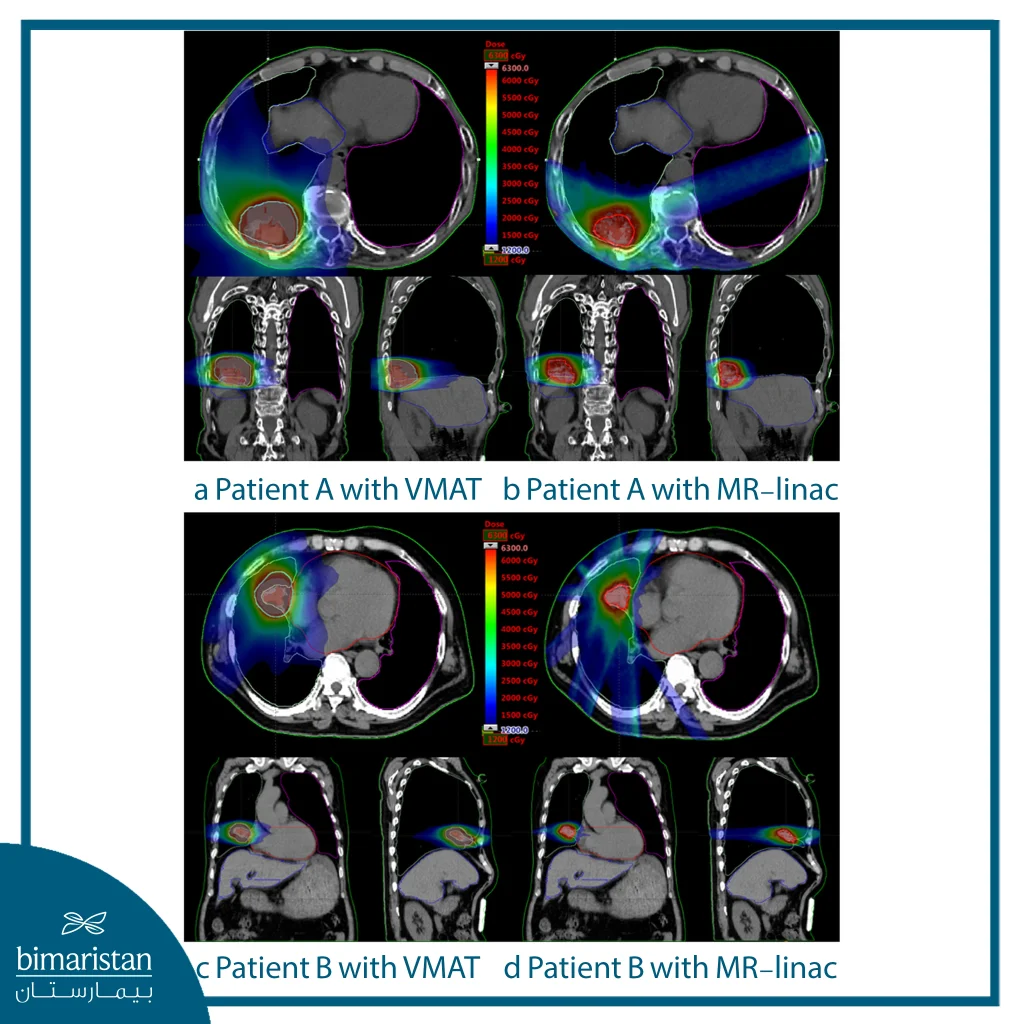 Comparative Dose-Distribution Images For Patients Treated With Vmat Versus Mr-Linac.