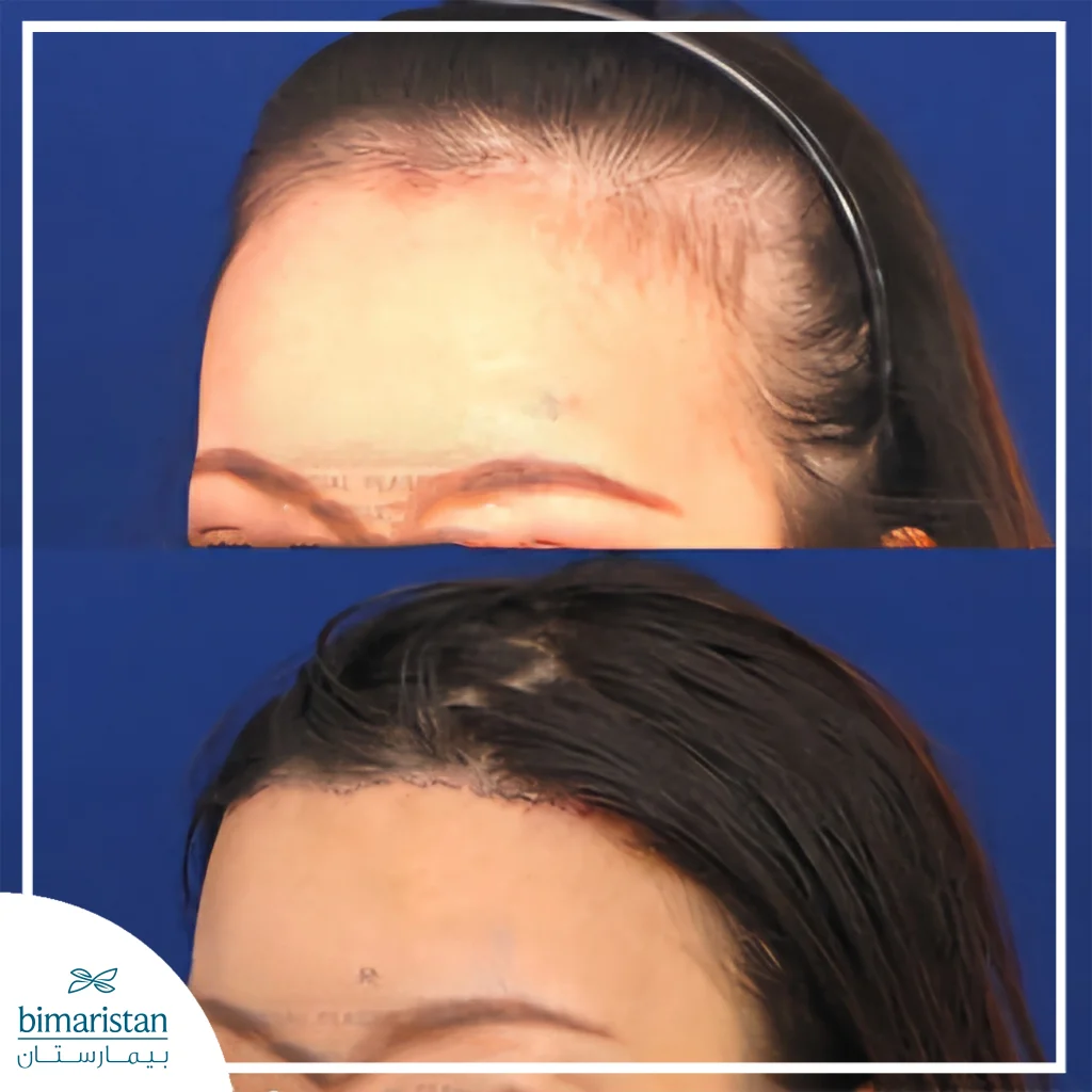 Comparison Image Showing Improvement In The Frontal Hairline Before Treatment And Six Days After.