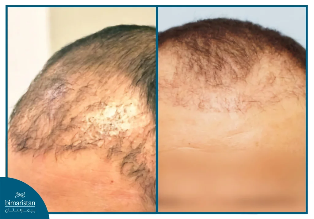 Comparison Image Showing The Scalp Appearance Before And After An Unsuccessful Hair Transplant, With Uneven Hair Density And Poor Graft Growth.